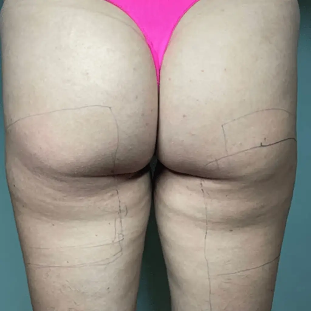Glutes before a receiving a non-surgical fat removal treatment