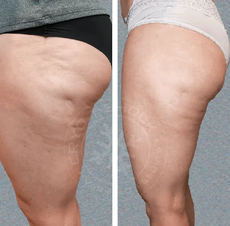 Cryo T-Shock before and after picture, showing the reduction in fat and cellulite in the glutes post-treatment.