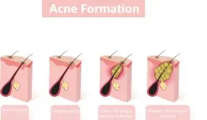 Skin Follicle showing how we get acne