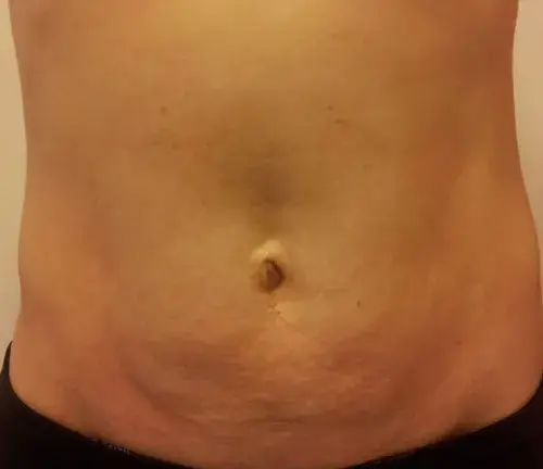 Firm skin on abdomen after LPG Endermologie treatment.