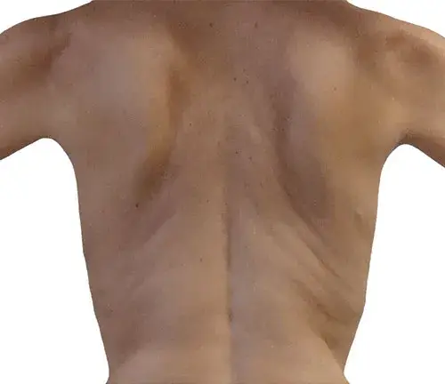 Results of smoothed back rolls after Endermologie body treatment.