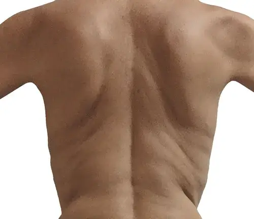 Back rolls before Endermologie body treatment.