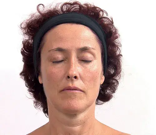 Woman's face following treatment to smooth and slim the face.