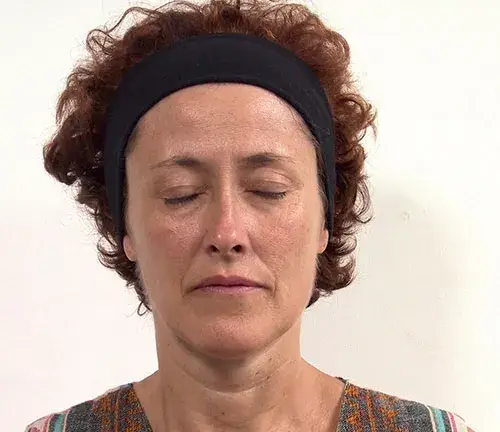 Woman's face before receiving treatment to smooth and slim the face
