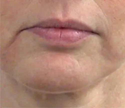 Woman's mouth seen with frown lines before face sculpting treatment.