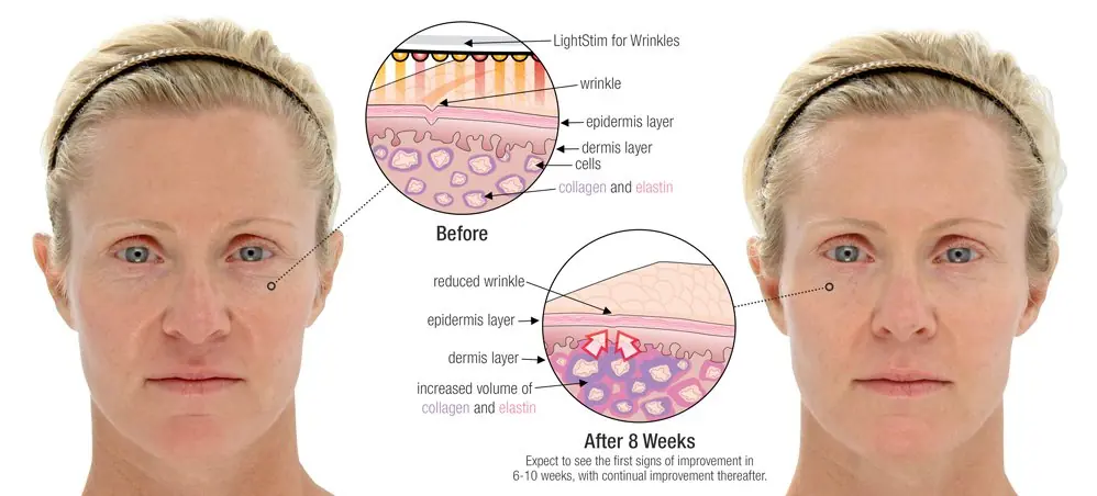 WomensFace before and after 8 weeks of LED Facial Treatment using LightStim