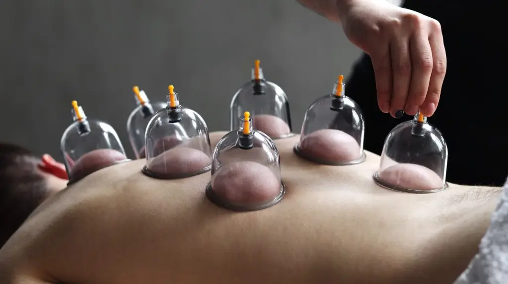 Male client receiving massage cupping therapy